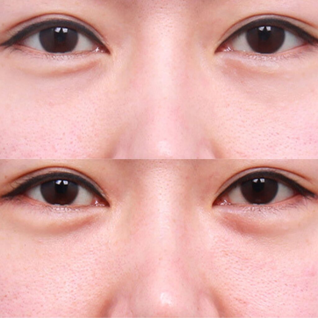 Scarless Under-Eye Puffiness Removal in Korea