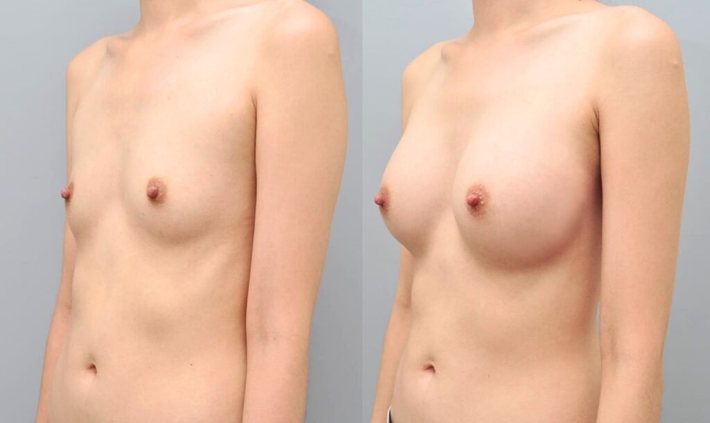 Sebbin Implants_ Results Revealed in Korea