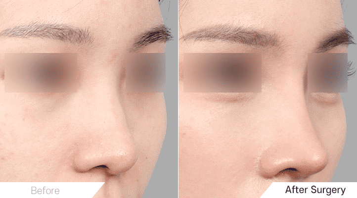 Secrets of Lengthening the Nose_ Choosing Rhinoplasty in Korea