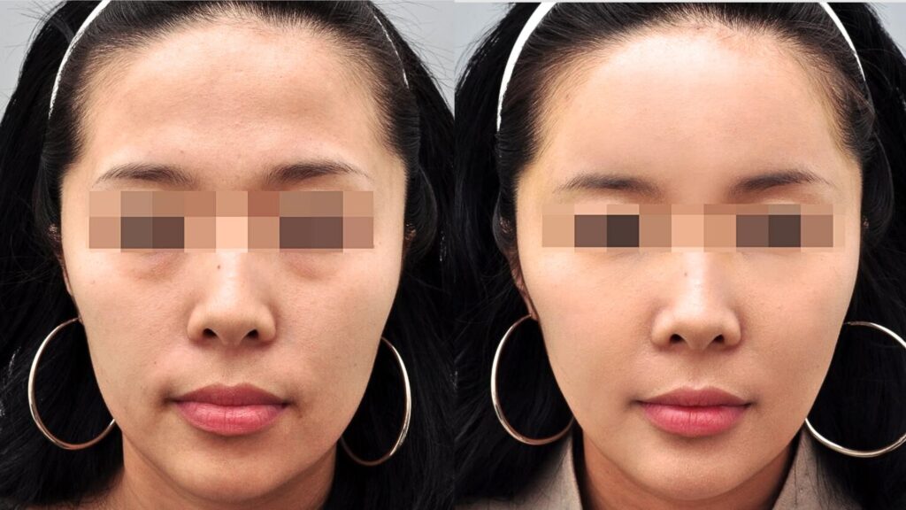 Secrets of Successful Facial Lipofilling