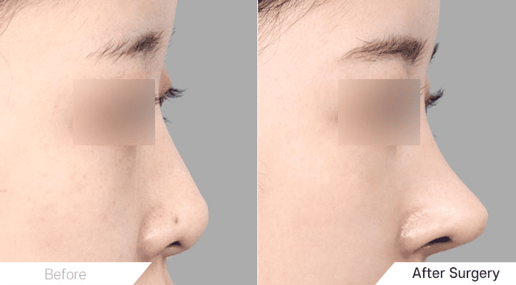 Secrets of Successful Short Nose Rhinoplasty in Korea