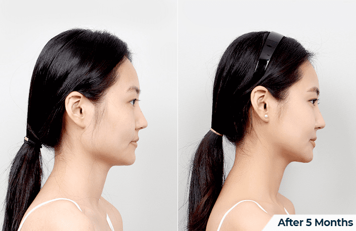 Secrets of a Beautiful Face_ Chin Reduction in Korea