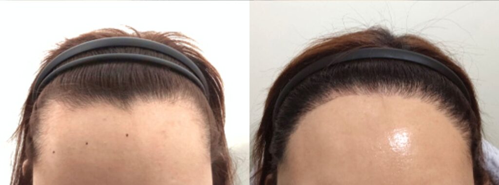 Secrets of successful hair transplant for women in Korea