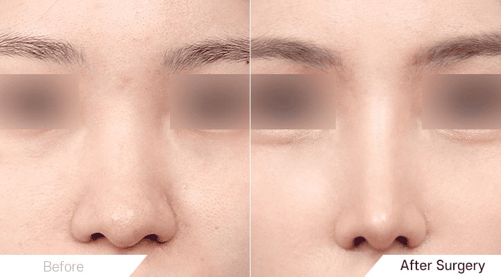 Short Nose Rhinoplasty_ Before and After in Korea