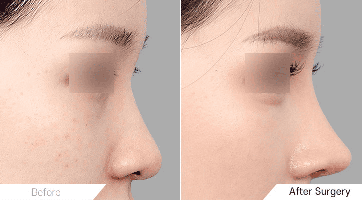 Short Nose Rhinoplasty_ Instructions and Recommendations in Korea