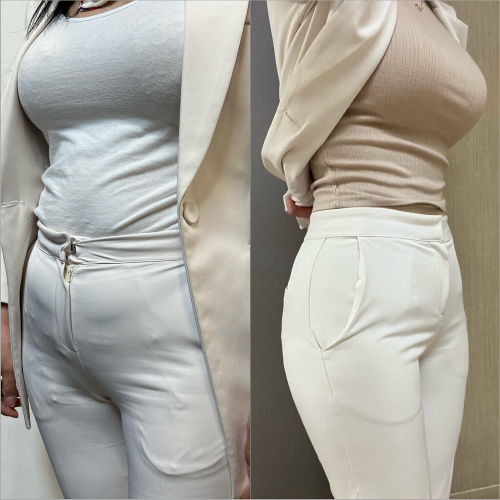 Side Stomach Liposuction in Korea