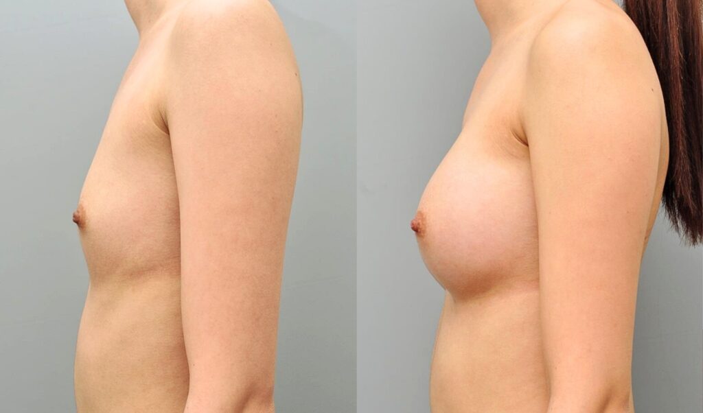 Silicone vs. Saline Implants_ Making the Choice in Korea