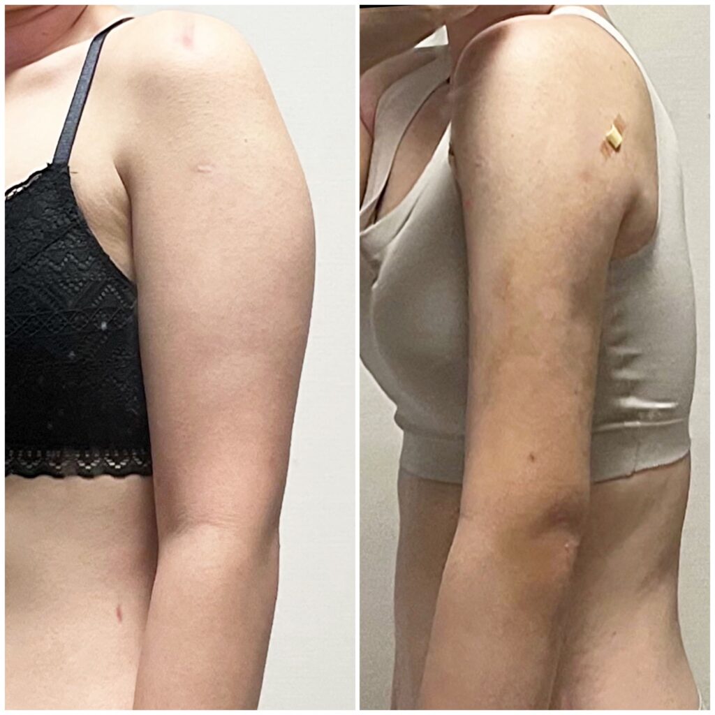 Skin Care After Arm Liposuction in Korea