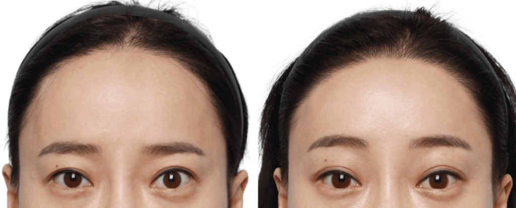 Skin Care After Forehead Lift in Korea