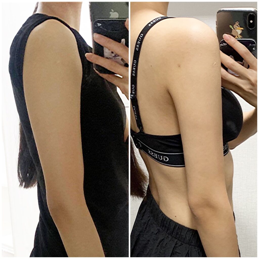 Skin Tightening After Arm Liposuction in Korea