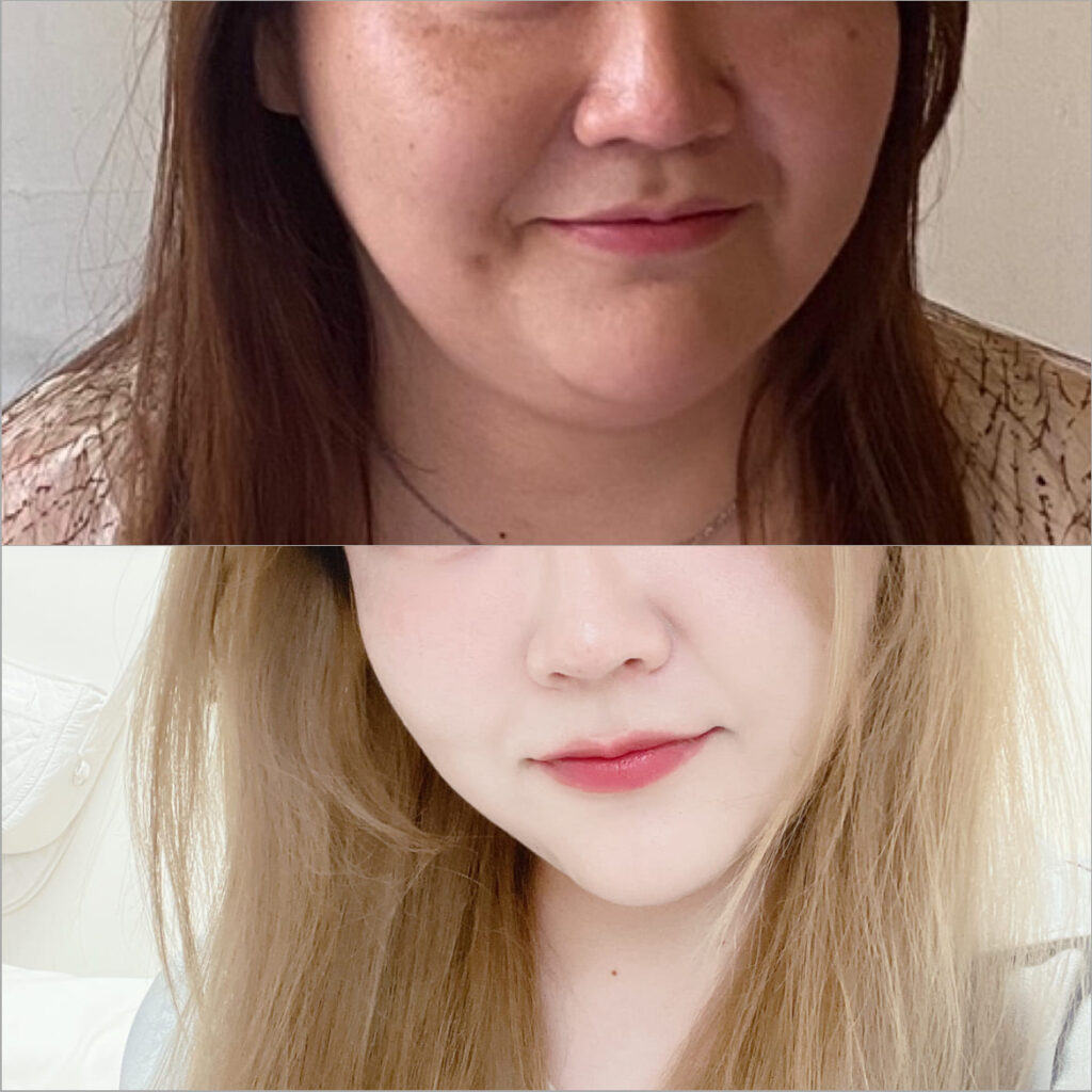 Skin Tightening After Face Liposuction in Korea