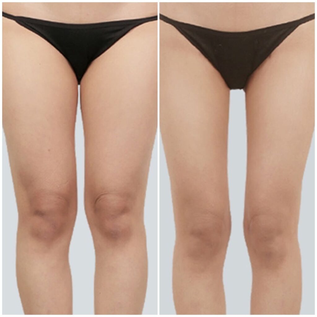 Slimming Legs with Liposuction Technique in Korea