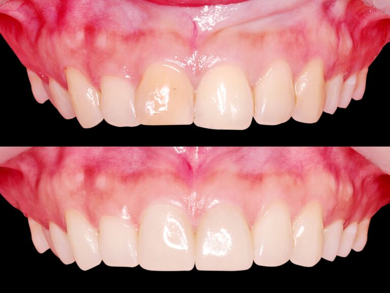 Smile makeover with veneers in Korea