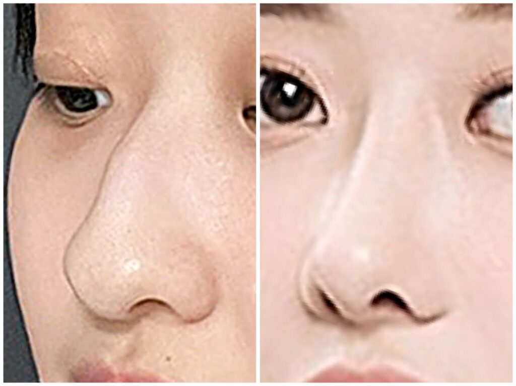 Smooth Nasal Line_ Secrets of Rhinoplasty in Korea