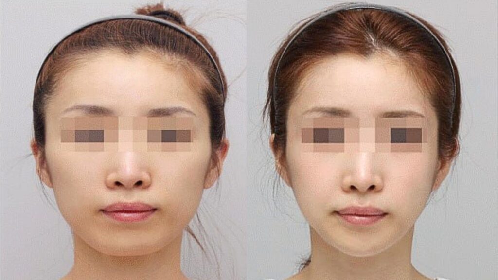 Softening Facial Features with Cheek Plastics in Korea