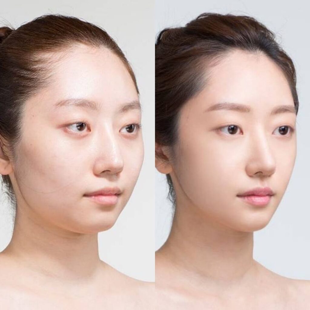 Square Jaw Correction Procedure in Korea