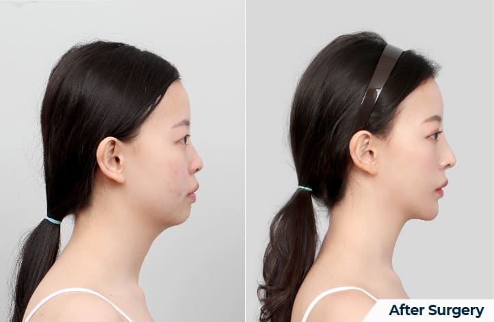 Square Jaw Correction for a Harmonious Face in Korea