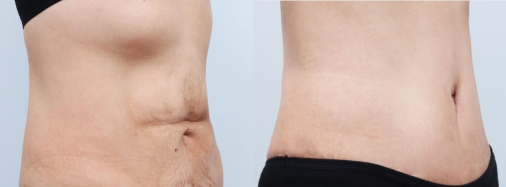 Stages of Abdominoplasty Surgery in Korea