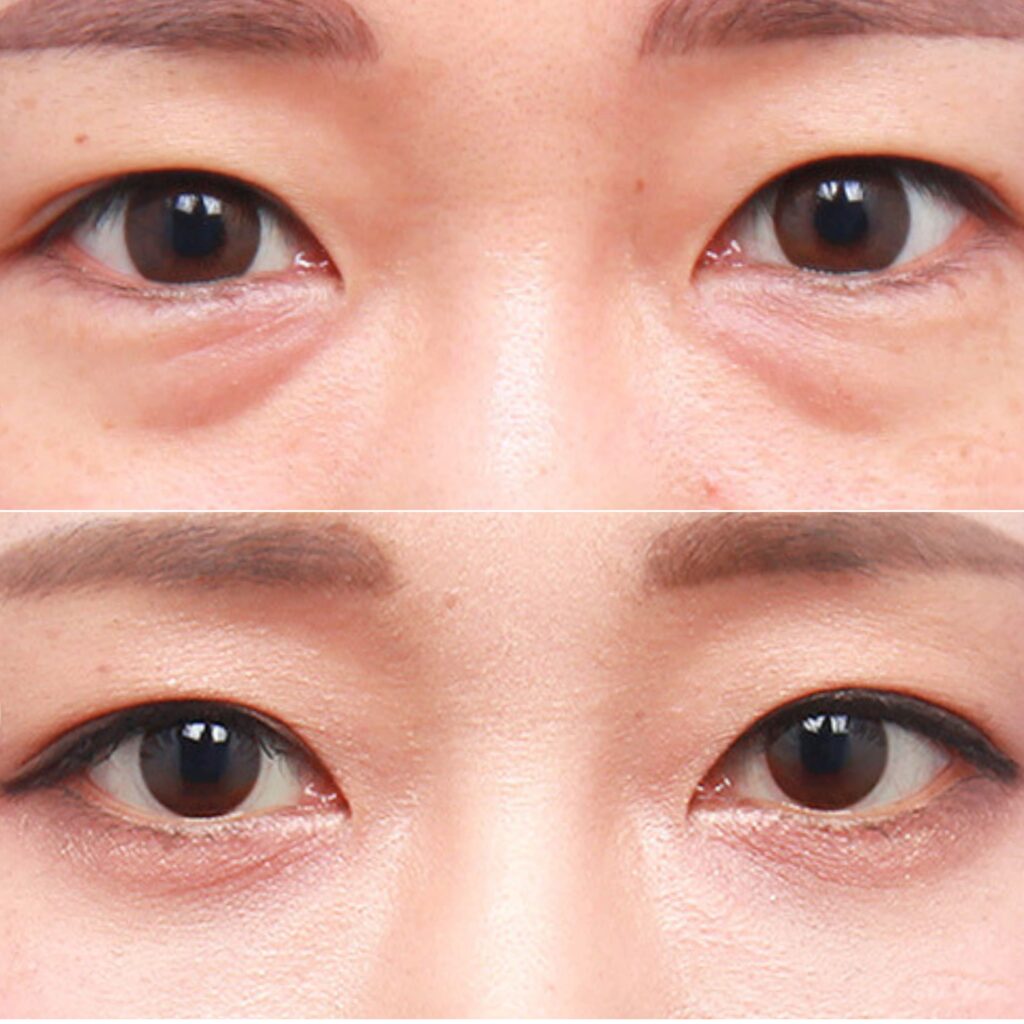 Stages of Transconjunctival Surgery in Korea