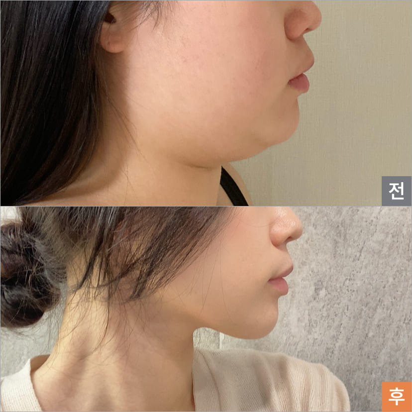 Steps of Face Liposuction in Korea