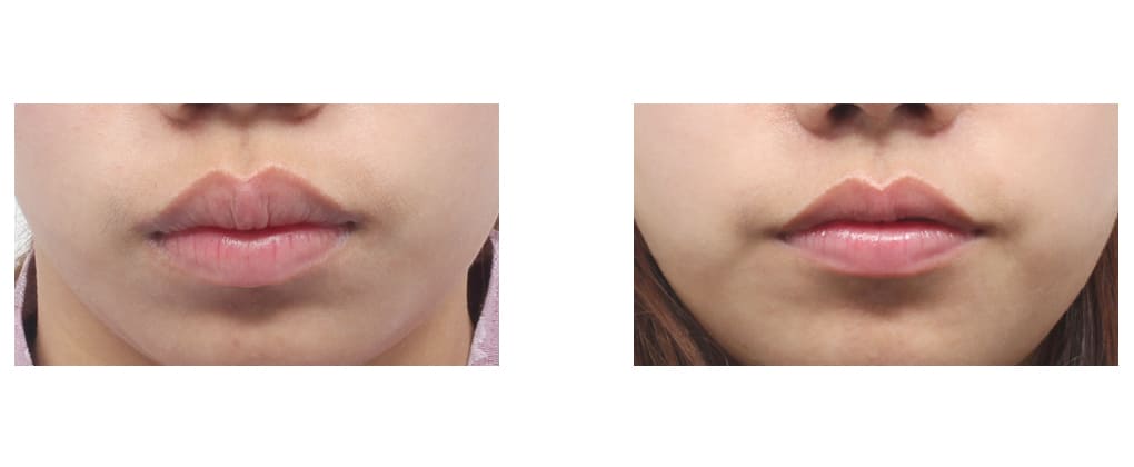 Steps of Lip Augmentation Procedure in Korea