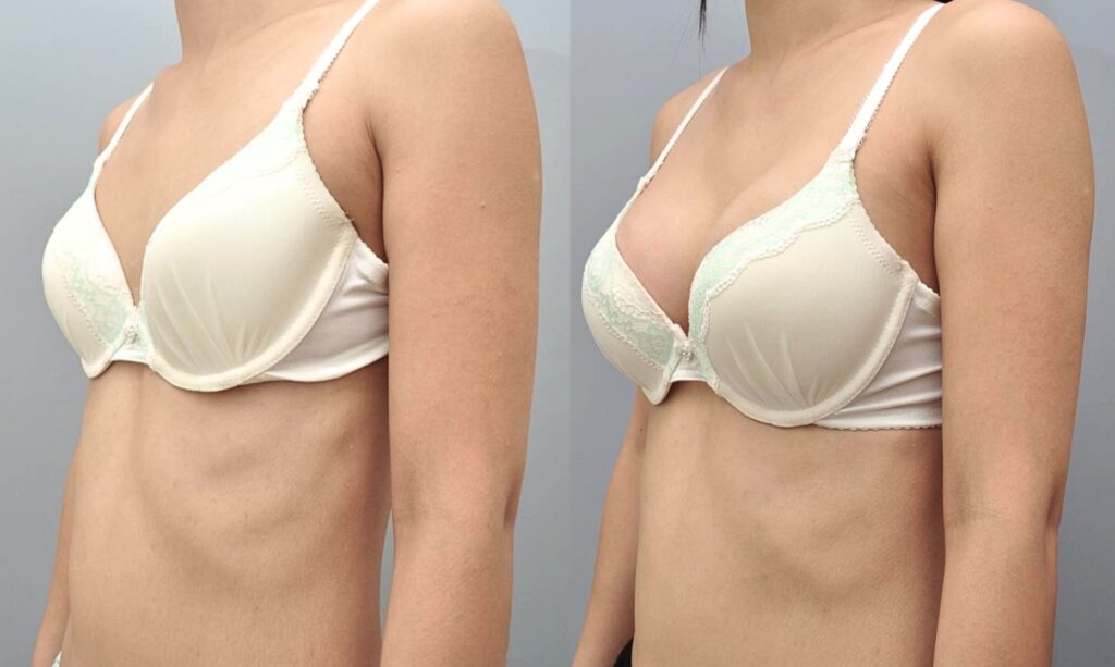 Success Stories in Breast Augmentation in Korea