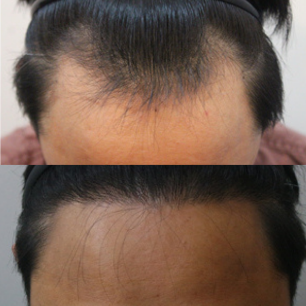 Successful Hair Transplant Procedure in Korea