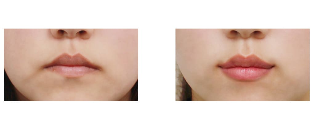 Successful Lip Augmentation Examples in Korea