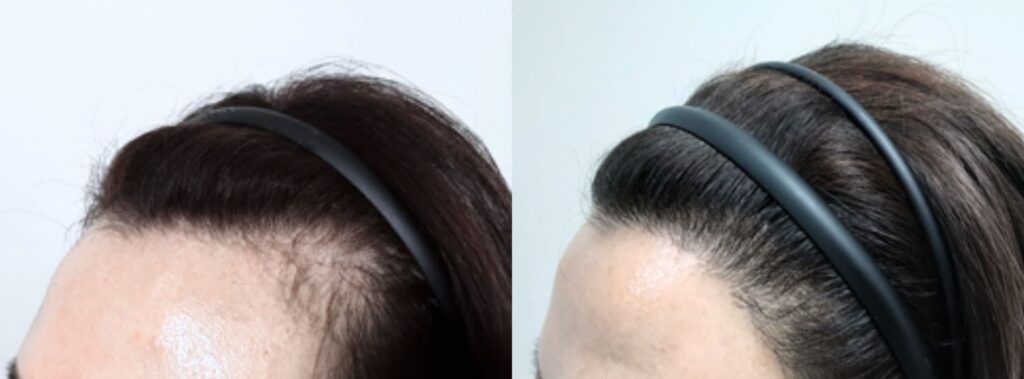 Successful hair transplant for women in Korea