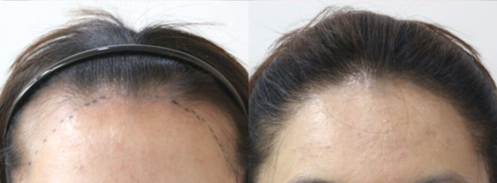 Successful hair transplant for women_ before and after in Korea