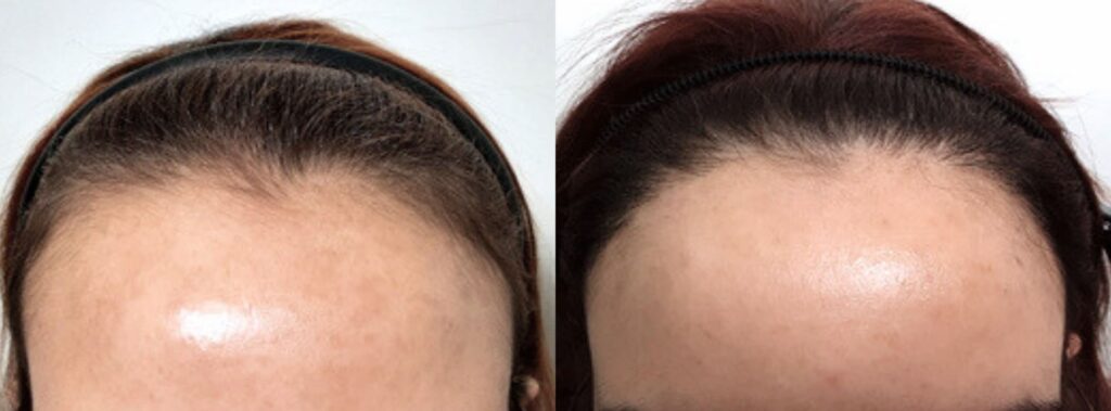 Successful hair transplant_ new life for women in Korea