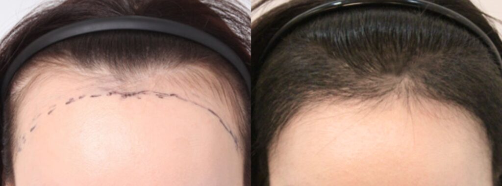 Successful hair transplant_ woman_s joy in Korea