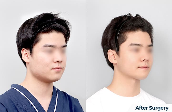 Surgical Change of Jaw Shape in Korea