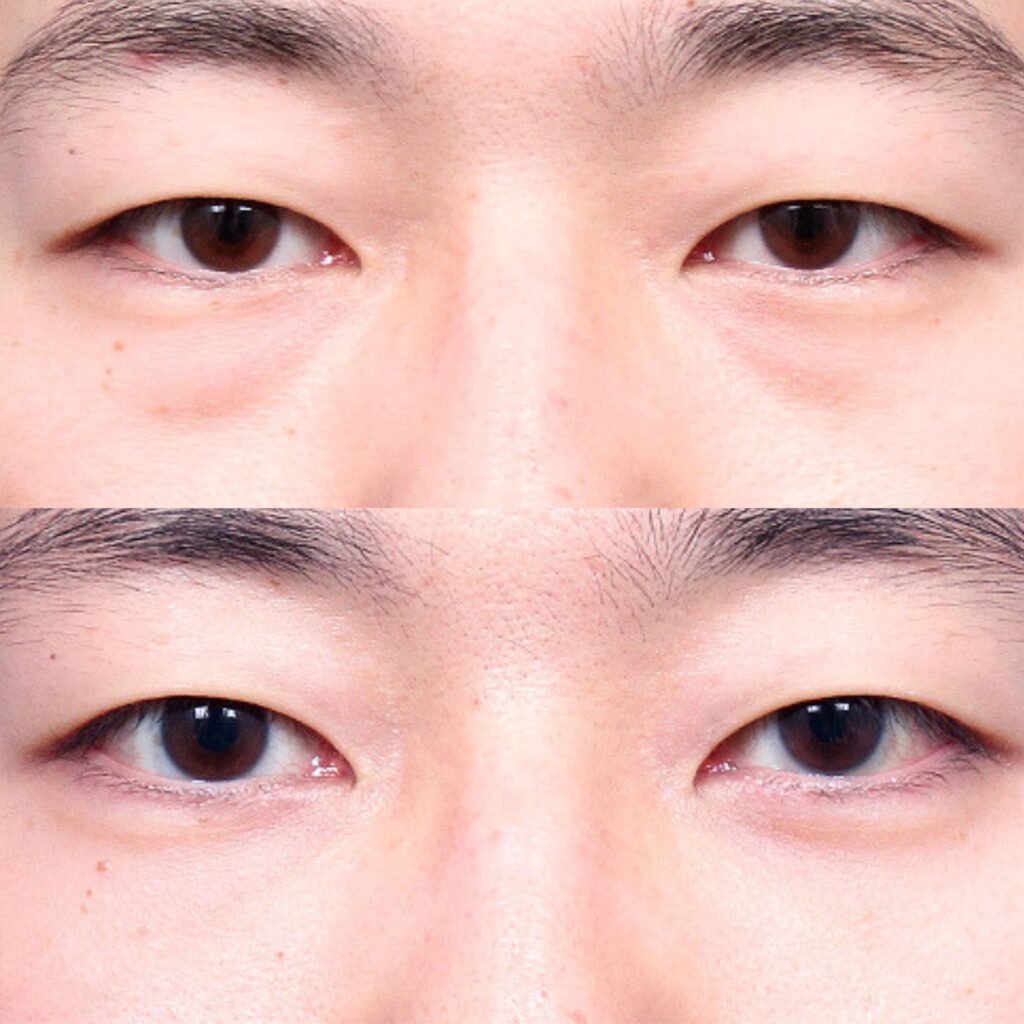 Surgical Removal of Dark Circles Under Eyes in Korea