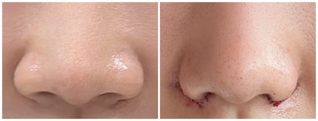 Techniques for Nasal Wing Correction in Korea