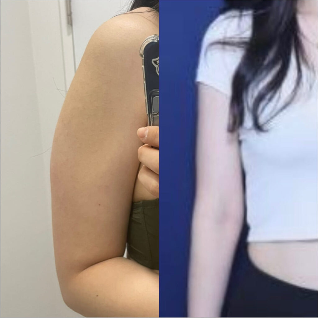 Techniques of Arm Liposuction in Korea