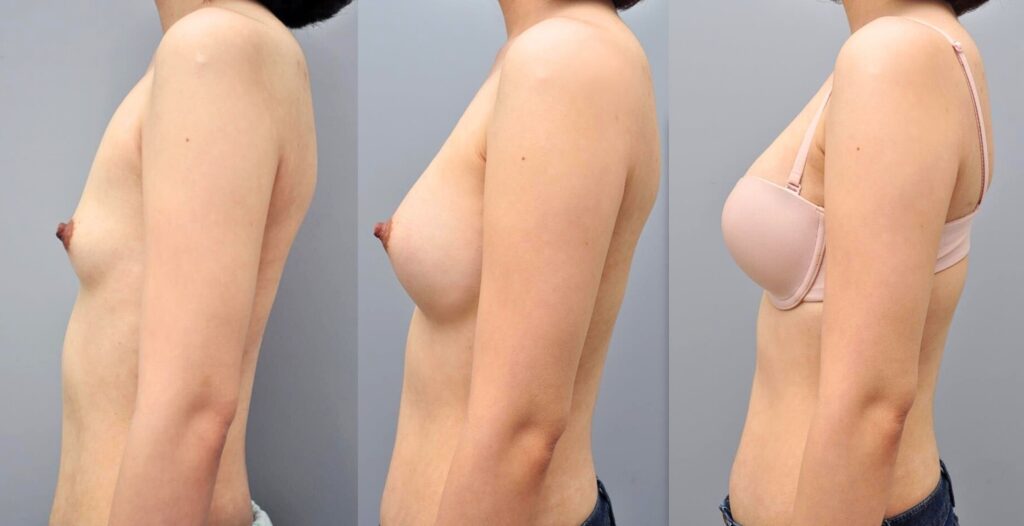 The Process of Breast Augmentation Surgery in Korea