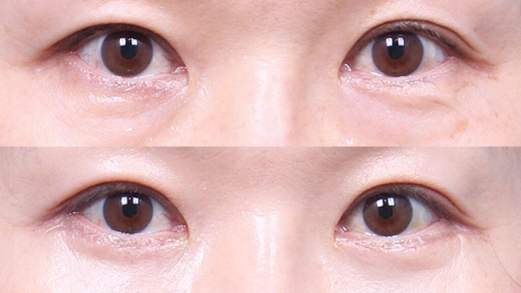 The Process of Lower Blepharoplasty in Korea