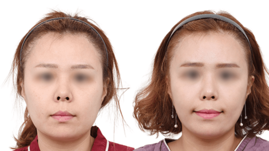 Thread lifting face_ before and after in Korea