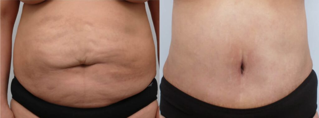 Tips Before Abdominoplasty in Korea