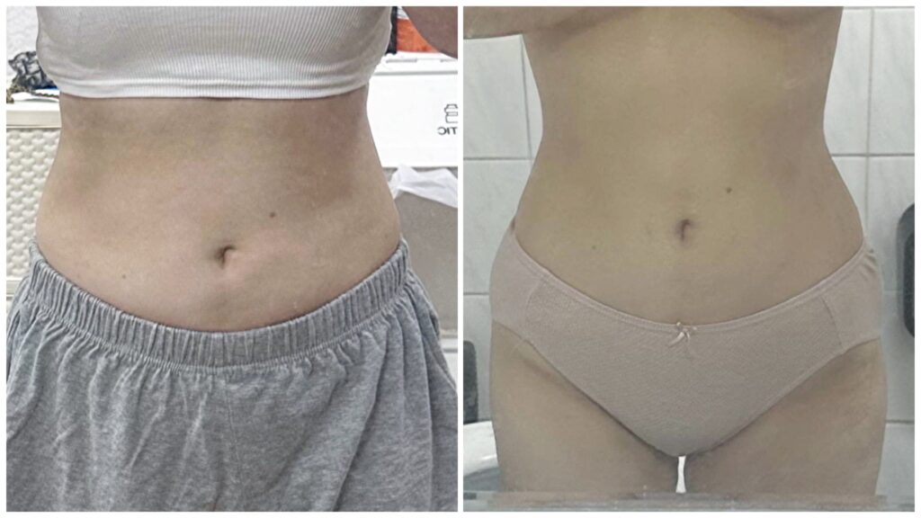 Tips after Abdominal Liposuction in Korea