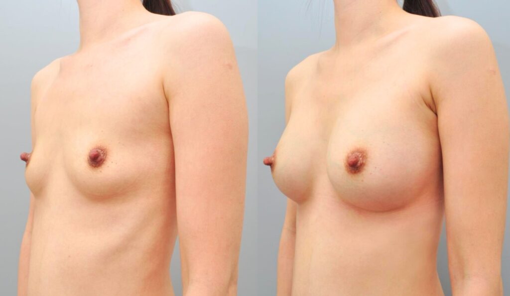 Top Clinics for Breast Augmentation in Korea