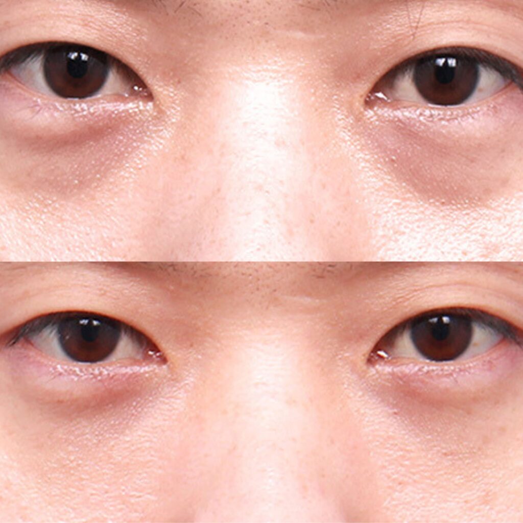 Transconjunctival Blepharoplasty_ Before and After in Korea