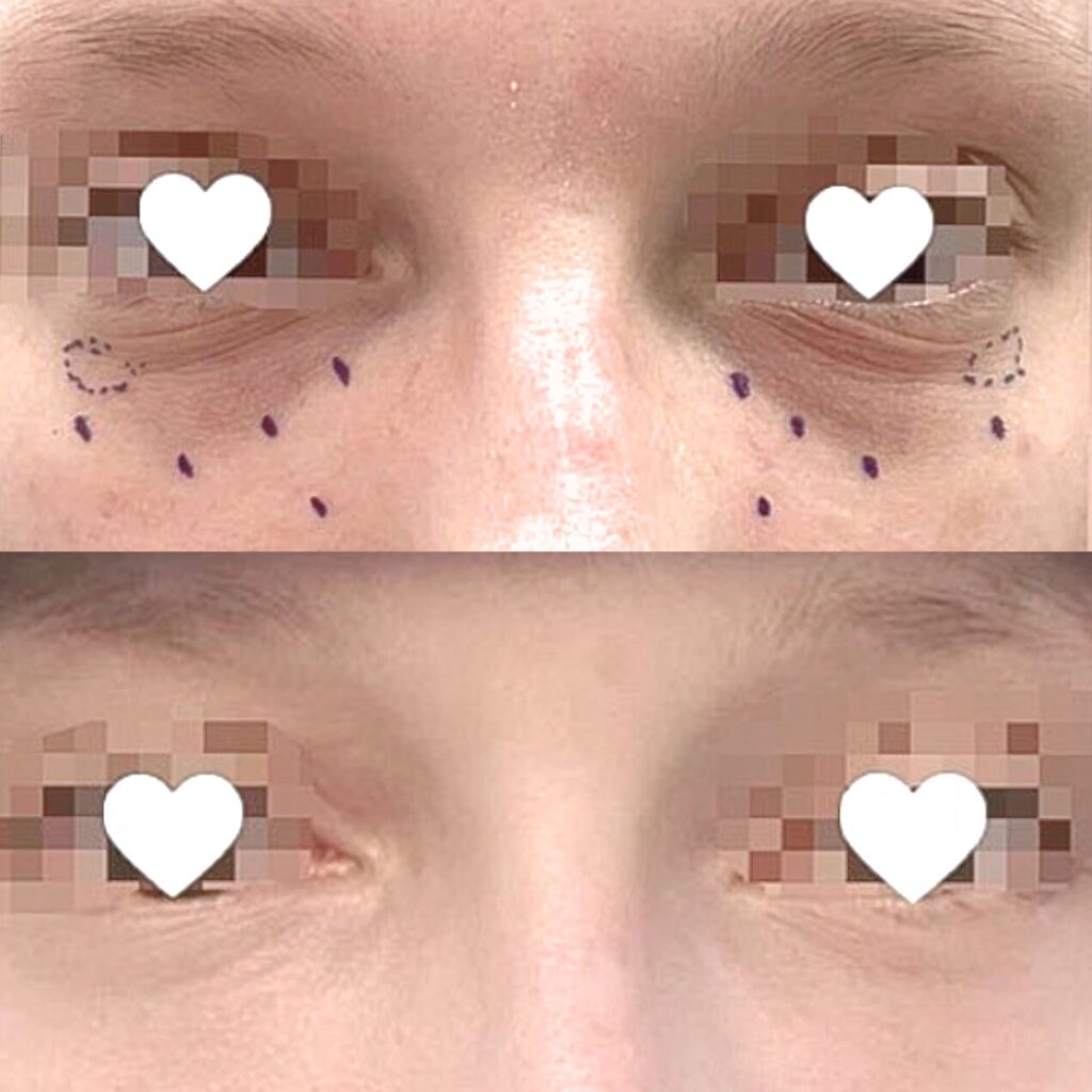 Transconjunctival vs. Traditional Blepharoplasty Comparison in Korea