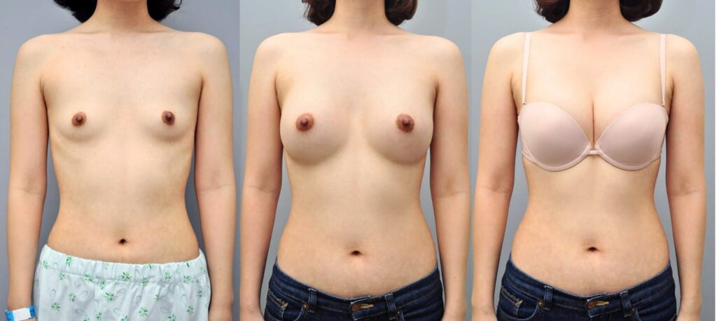 Transformation Journey_ Breast Augmentation Photos in Korea