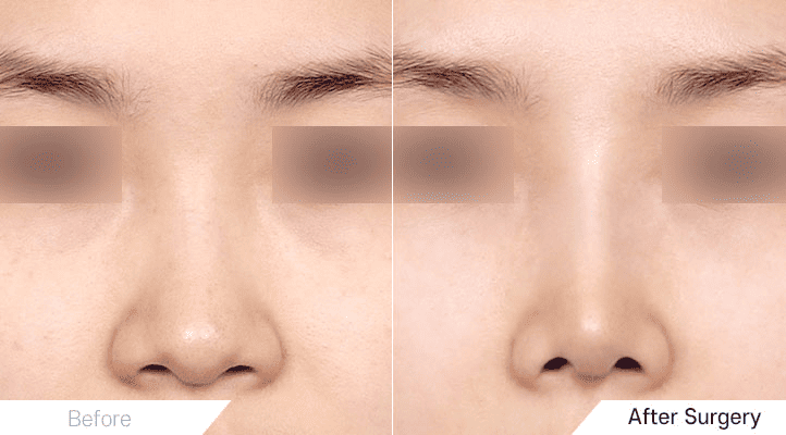 Transformation_ Lengthening the Short Nose with Rhinoplasty in Korea