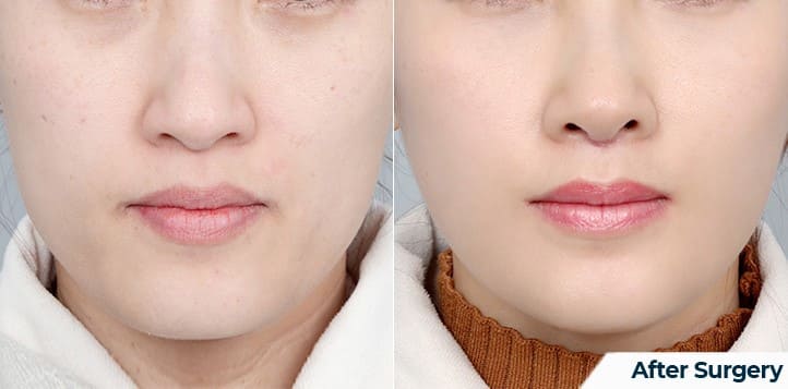 Transformations with Korean Face Lifting