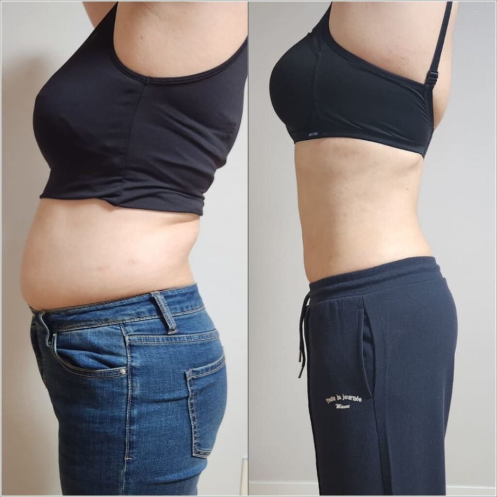 Types of Abdominal Liposuction Procedures in Korea