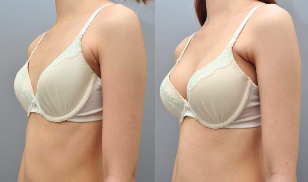 Types of Anesthesia for Breast Surgery in Korea