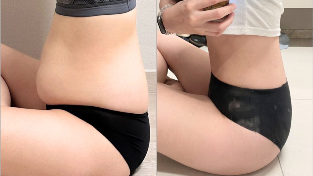 Types of Anesthesia for Buttock Lipofilling in Korea